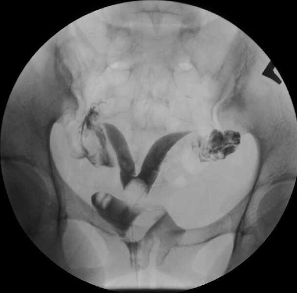 File:Bicornuate or septate-subseptate uterus (Radiopaedia 7700-8519 Frontal 1).jpg