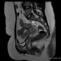Bicornuate uterus- on MRI (Radiopaedia 49206-54297 Sagittal T2 11).jpg