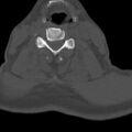 Bilateral C6-7 locked facet dislocation (Radiopaedia 28506-28748 Axial bone window 12).jpeg