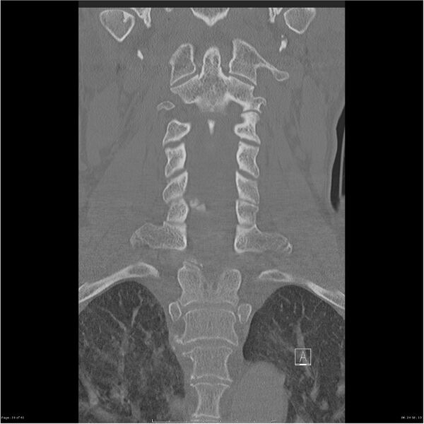File:Bilateral cervical ribs (Radiopaedia 25868-26017 Coronal bone window 19).jpg