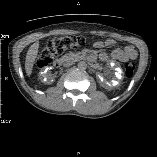 File:Bilateral medullary nephrocalcinosis with ureteric calculi (Radiopaedia 71269-81569 Axial non-contrast 44).jpg