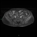 Bilateral ovarian fibroma (Radiopaedia 44568-48293 Axial T1 C+ fat sat 5).jpg