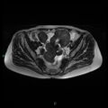 Bilateral ovarian fibroma (Radiopaedia 44568-48293 Axial T2 12).jpg