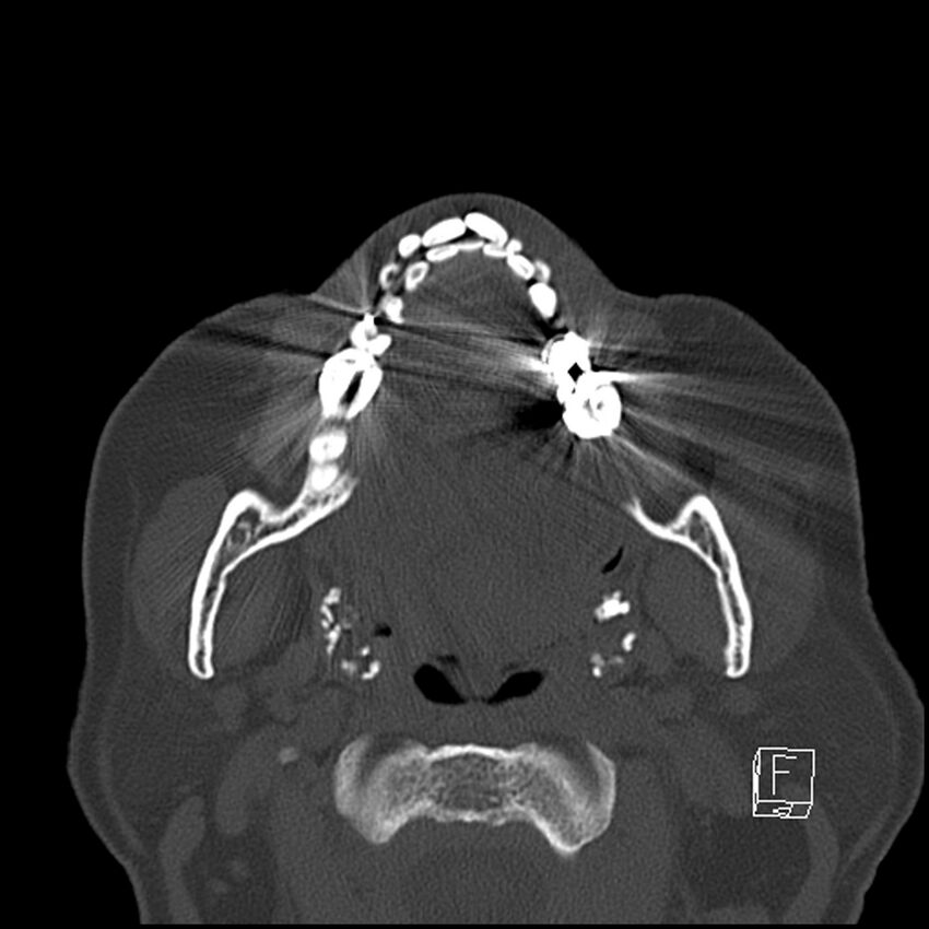 Bilateral palatine tonsilloliths on OPG and CT (Radiopaedia 75167-86247 Axial bone window 41).jpg