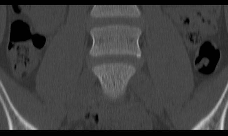 File:Bilateral pars defect (Radiopaedia 26691-26846 Coronal bone window 11).jpg