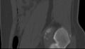 Bilateral pars defect (Radiopaedia 26691-26846 Sagittal bone window 56).jpg