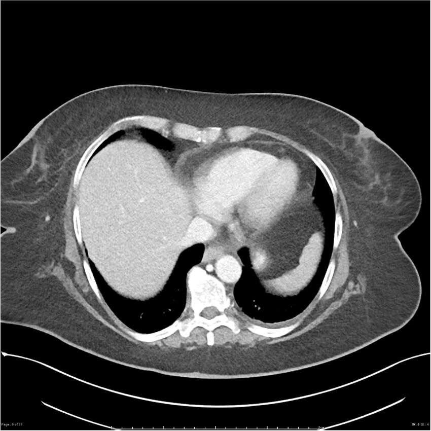 Bilateral psoas hematomas (Radiopaedia 24057-24279 A 9).jpg