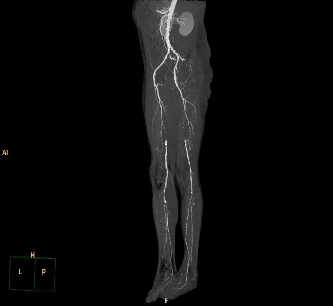 File:Bilateral superficial femoral arterial occlusion (Radiopaedia 25682-25857 3D MIP 17).jpg