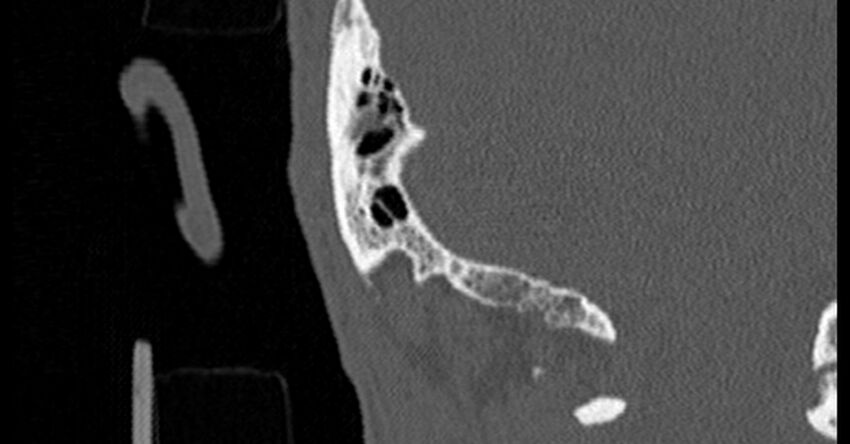 Bilateral temporal bone fractures (Radiopaedia 29482-29970 Coronal non-contrast 174).jpg