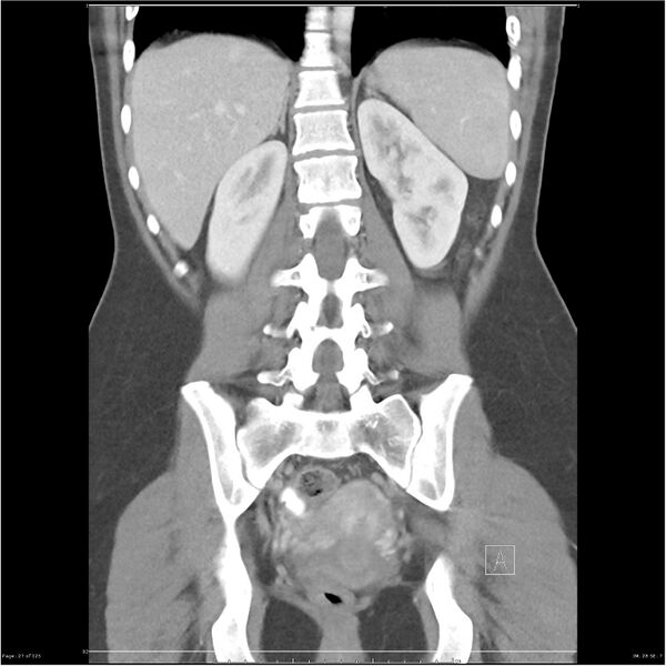 File:Bilateral ureteritis and cystitis (Radiopaedia 25340-25594 B 27).jpg