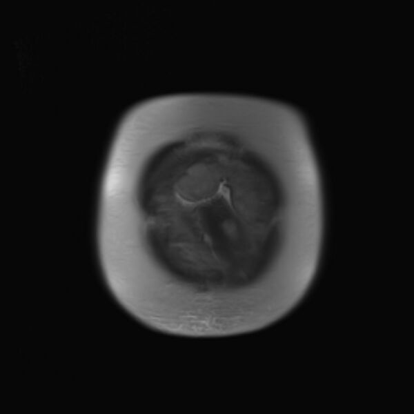 File:Bilobed placenta accreta (Radiopaedia 69648-79591 Coronal T2 4).jpg