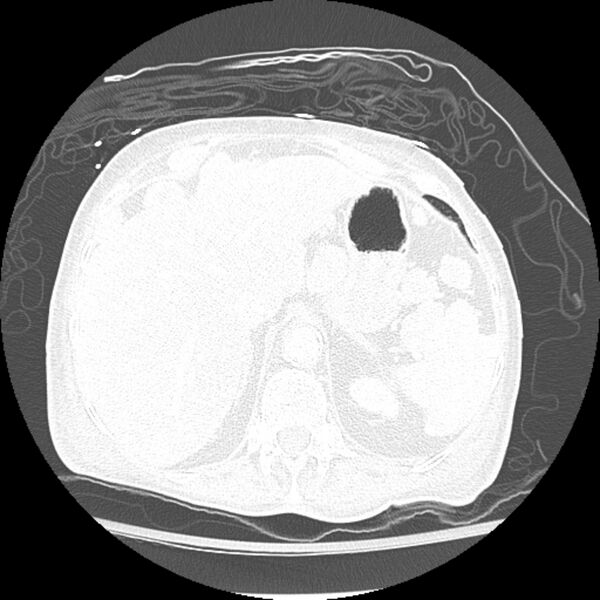 File:Bladder cancer metastases (Radiopaedia 9824-10409 Axial lung window 13).jpg
