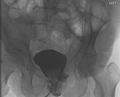 Bladder leak post radical prostatectomy (Radiopaedia 34569-35946 C 1).PNG