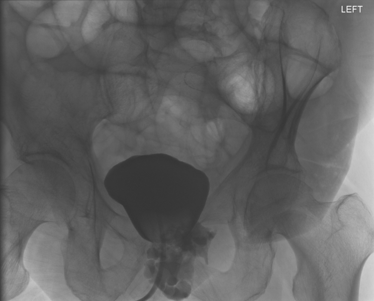 File:Bladder leak post radical prostatectomy (Radiopaedia 34569-35946 C 1).PNG
