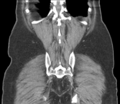 Bladder papillary urothelial carcinoma (Radiopaedia 48119-52951 C 55).png