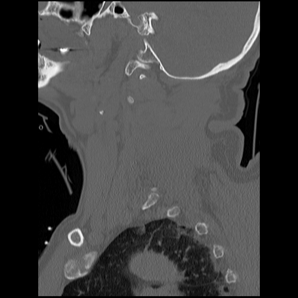 File:Blunt cerebrovascular injury (Radiopaedia 53682-59743 Sagittal bone window 2).png