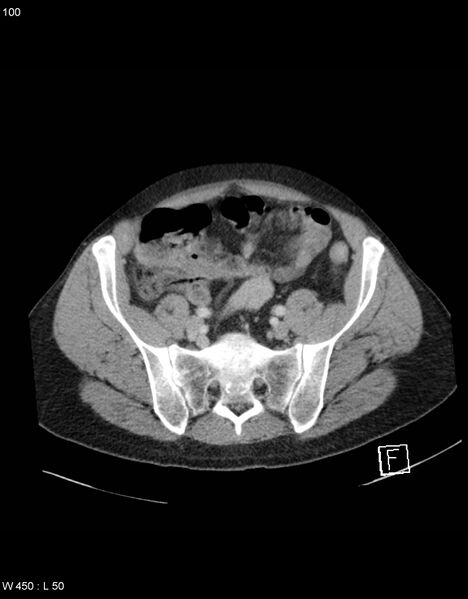 File:Boerhaave syndrome with tension pneumothorax (Radiopaedia 56794-63603 A 50).jpg