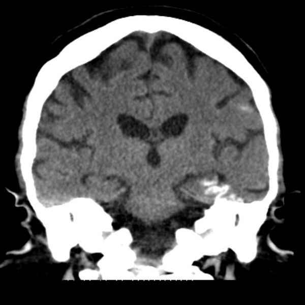 File:Brain cortical laminar necrosis (Radiopaedia 25822-25971 C 32).jpg