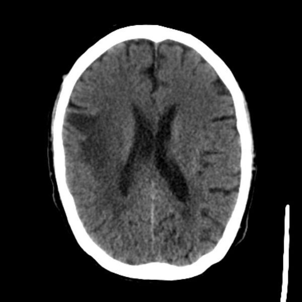 File:Brain metastases from lung cancer (Radiopaedia 27849-28092 Axial non-contrast 28).jpg