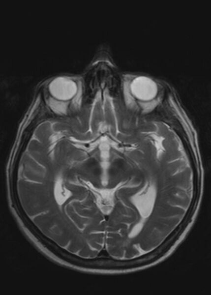 File:Brain metastases from squamocellular lung cancer (Radiopaedia 56515-63222 Axial T2 12).jpg