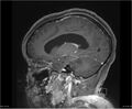 Brainstem glioma (Radiopaedia 21819-21775 D 27).jpg