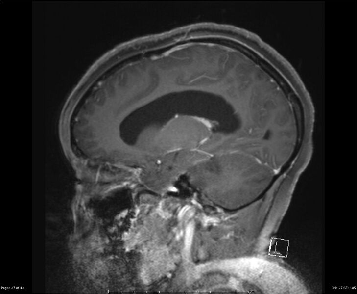File:Brainstem glioma (Radiopaedia 21819-21775 D 27).jpg