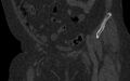 Breast carcinoma with pathological hip fracture (Radiopaedia 60314-67993 Coronal bone window 53).jpg
