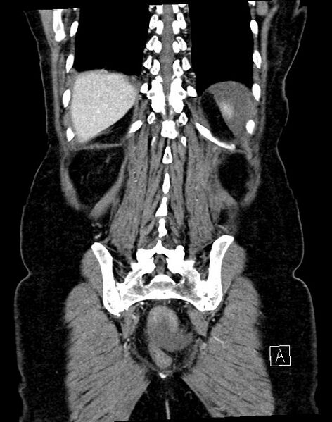 File:Broad ligament hernia (Radiopaedia 84802-100276 B 8).jpg