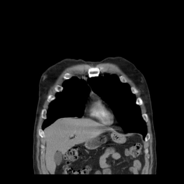 File:Bronchogenic carcinoma with upper lobe collapse (Radiopaedia 29297-29726 D 13).jpg