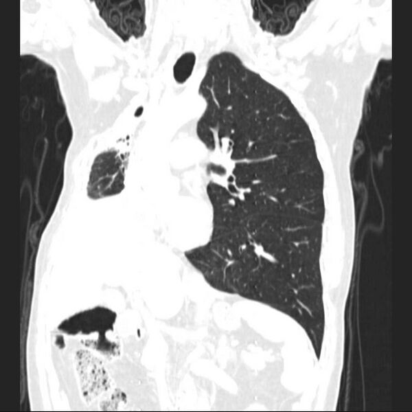 File:Bronchopleural fistula - postoperative complication (Radiopaedia 21020-20947 Coronal lung window 13).jpg