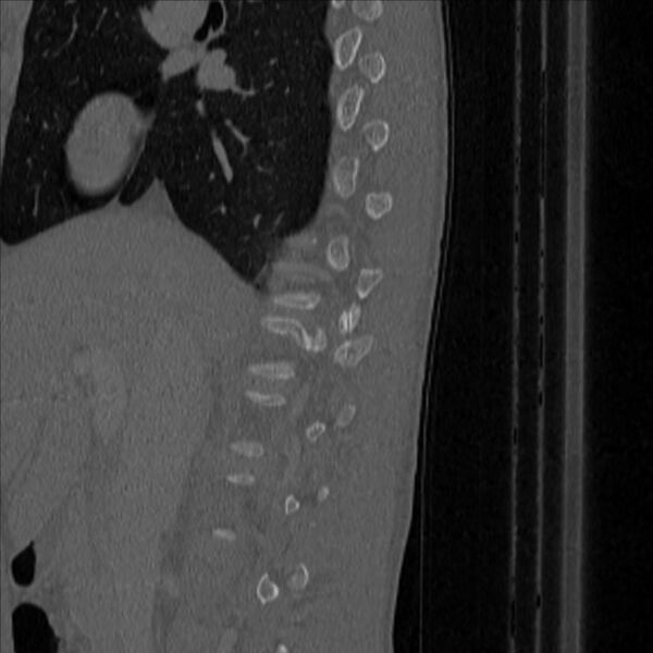 File:Bulging of paraspinal line in traumatic thoracal spinal compression fracture (Radiopaedia 29221-35872 Sagittal bone window 3).jpg