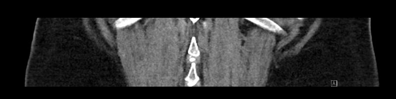 File:Buried bumper syndrome - gastrostomy tube (Radiopaedia 63843-72575 Coronal Inject 89).jpg