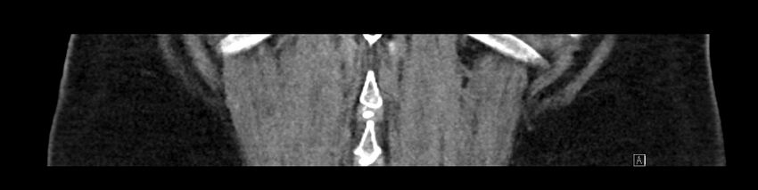 Buried bumper syndrome - gastrostomy tube (Radiopaedia 63843-72575 Coronal Inject 89).jpg