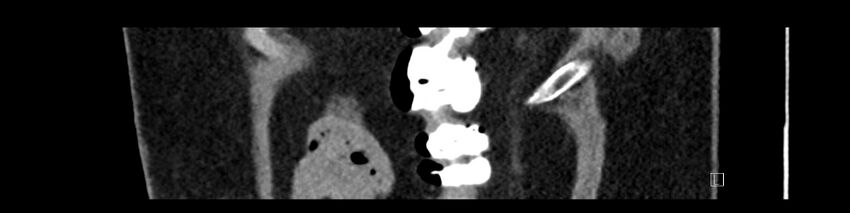 Buried bumper syndrome - gastrostomy tube (Radiopaedia 63843-72575 Sagittal Inject 14).jpg