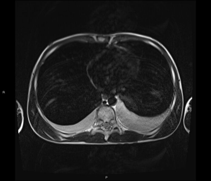 File:Burkitt lymphoma (bowel) (Radiopaedia 68839-78557 Axial T2 2).jpg