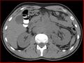 Burned-out testicular choriocarcinoma (Radiopaedia 32822-34040 Axial non-contrast 7).jpg