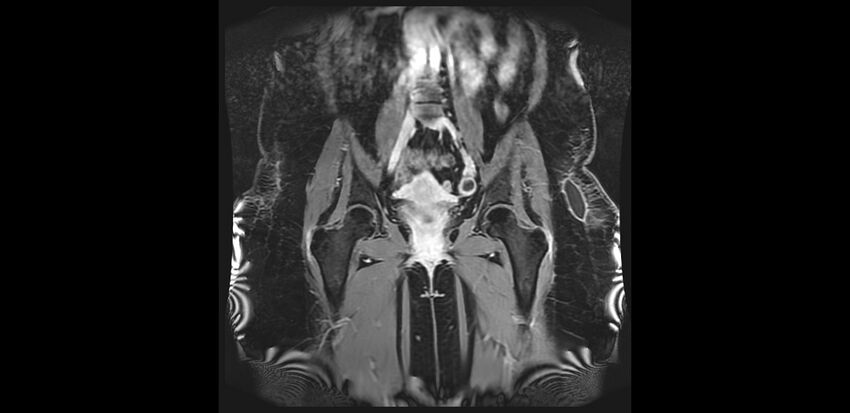 Buttock filler complications (Radiopaedia 63497-72115 Coronal T1 C+ 17).jpg