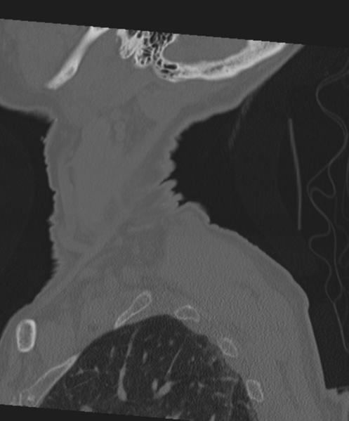 File:C2 fracture with vertebral artery dissection (Radiopaedia 37378-39199 Sagittal bone window 9).png