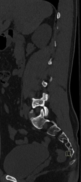 File:Calcaneal fractures with associated L2 burst fracture (Radiopaedia 71671-82493 Sagittal bone window 60).jpg