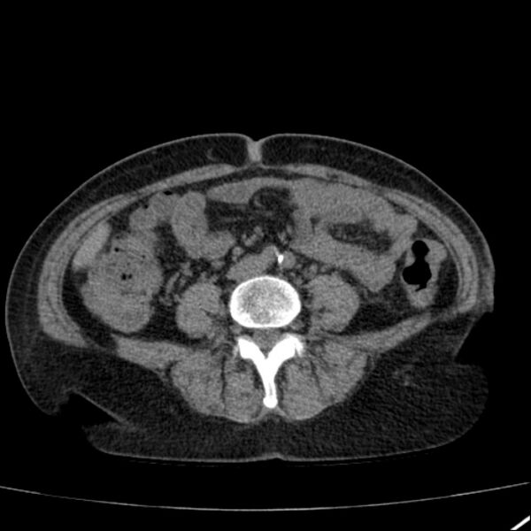 File:Calcified hepatic hydatid cyst (Radiopaedia 26872-27046 Axial non-contrast 53).jpg