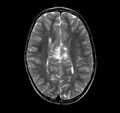 Callosal dysgenesis and ectopic posterior pituitary (Radiopaedia 8382-9213 Axial T2 4).jpg