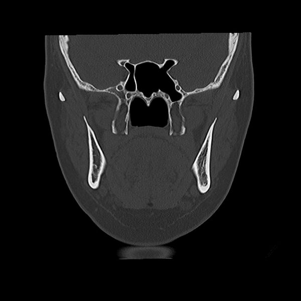 File:Canal up mastoidectomy (Radiopaedia 78108-90638 Coronal bone window 18).jpg