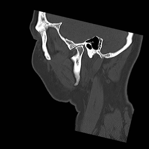 File:Canal up mastoidectomy (Radiopaedia 78108-90638 Sagittal bone window 12).jpg