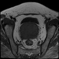 Cancer cervix - stage IIb (Radiopaedia 75411-86615 Axial T1 18).jpg