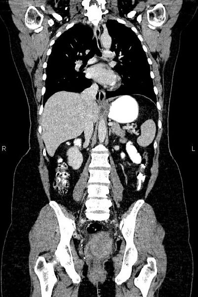File:Carcinoma of uterine cervix (Radiopaedia 85861-101700 C 33).jpg