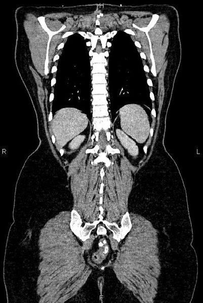 File:Carcinoma of uterine cervix (Radiopaedia 85861-101700 C 48).jpg