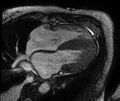Cardiac amyloidosis (Radiopaedia 61600-69579 A 11).jpg