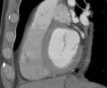 Cardiac hemangioma (Radiopaedia 16971-16679 C 6).JPG
