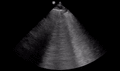 Cardiogenic pulmonary edema (ultrasound) (Radiopaedia 62735-71050 A 1).gif