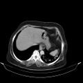 Carotid body tumor (Radiopaedia 21021-20948 A 49).jpg